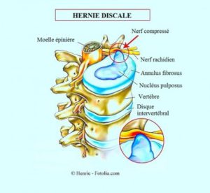 hernie discale